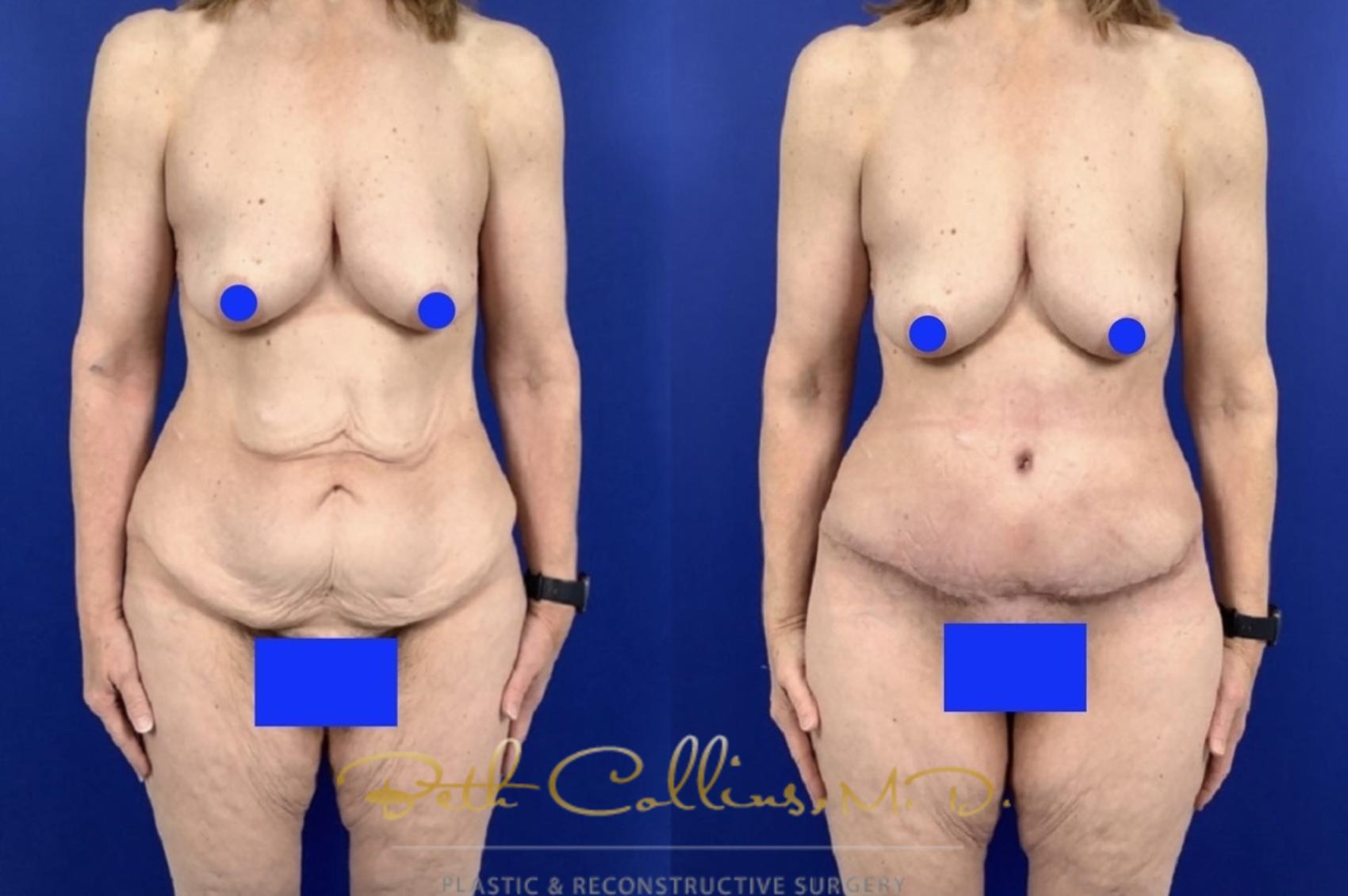Before & After Tummy Tuck Case 239 Front View in Guilford, CT