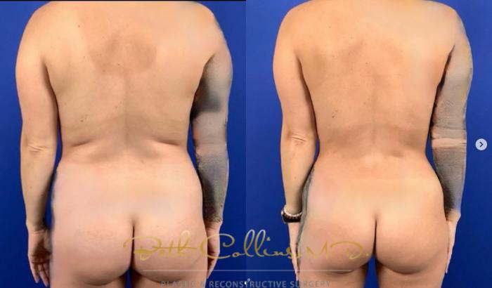 Before & After Tummy Tuck Case 283 Back View in Guilford, CT