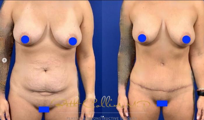 Before & After Tummy Tuck Case 283 Front View in Guilford, CT