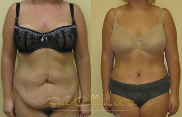 Before & After Tummy Tuck Case 4 View #1 View in Guilford, CT