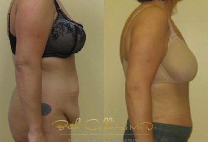 Before & After Tummy Tuck Case 4 View #2 View in Guilford, CT