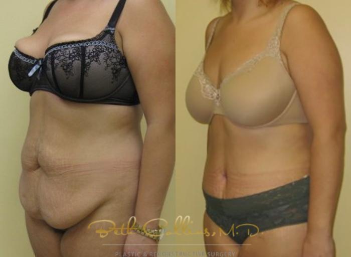 Before & After Tummy Tuck Case 4 View #3 View in Guilford, CT