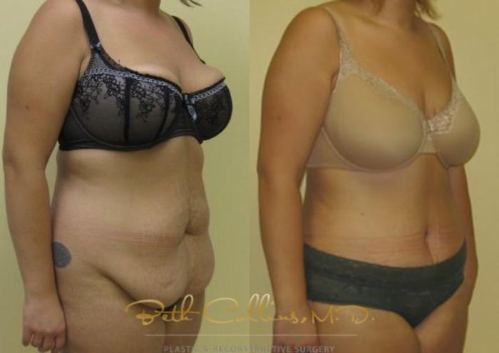 Before & After Tummy Tuck Case 4 View #4 View in Guilford, CT