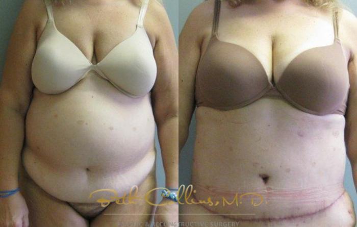 Before & After Tummy Tuck Case 5 View #1 View in Guilford, CT