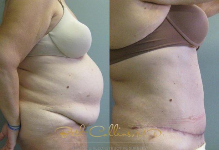 Before & After Tummy Tuck Case 5 View #2 View in Guilford, CT