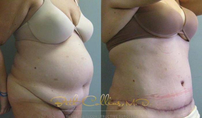 Before & After Tummy Tuck Case 5 View #3 View in Guilford, CT