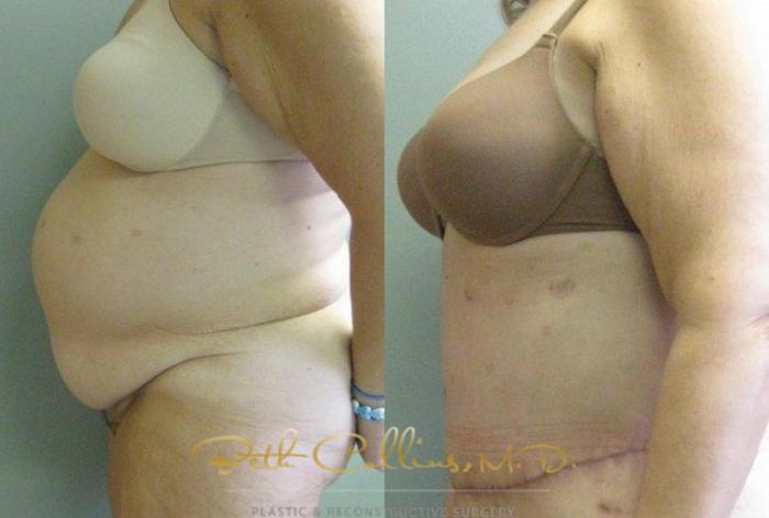 Before & After Tummy Tuck Case 5 View #4 View in Guilford, CT