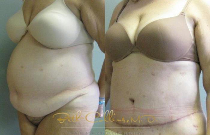 Before & After Tummy Tuck Case 5 View #5 View in Guilford, CT