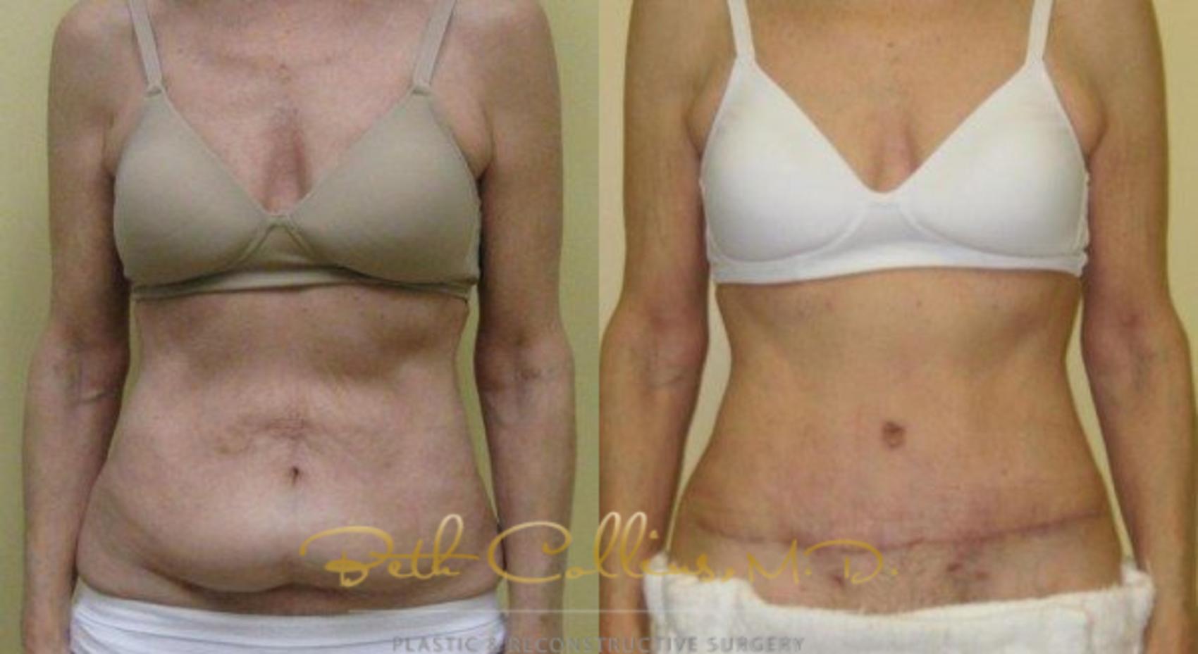 Before & After Tummy Tuck Case 6 View #1 View in Guilford, CT