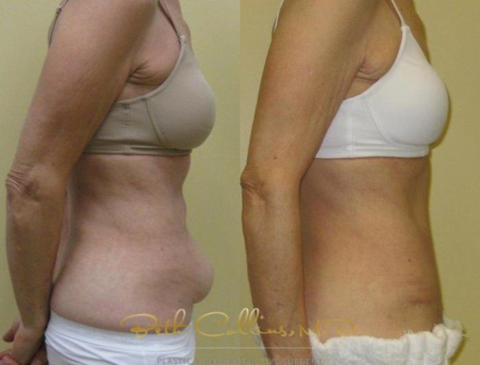 Before & After Tummy Tuck Case 6 View #2 View in Guilford, CT