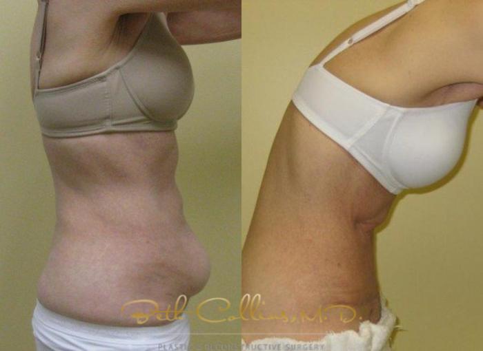 Before & After Tummy Tuck Case 6 View #3 View in Guilford, CT