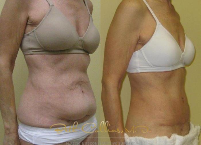 Before & After Tummy Tuck Case 6 View #4 View in Guilford, CT