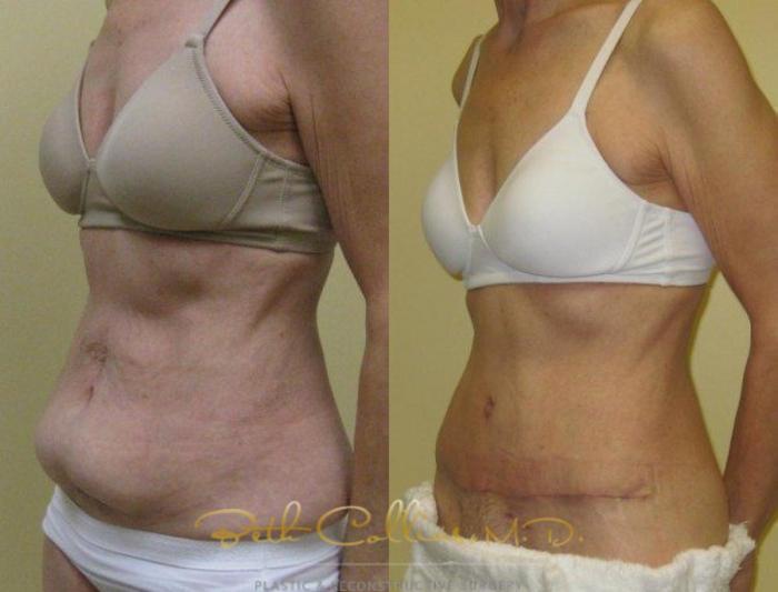 Before & After Tummy Tuck Case 6 View #5 View in Guilford, CT