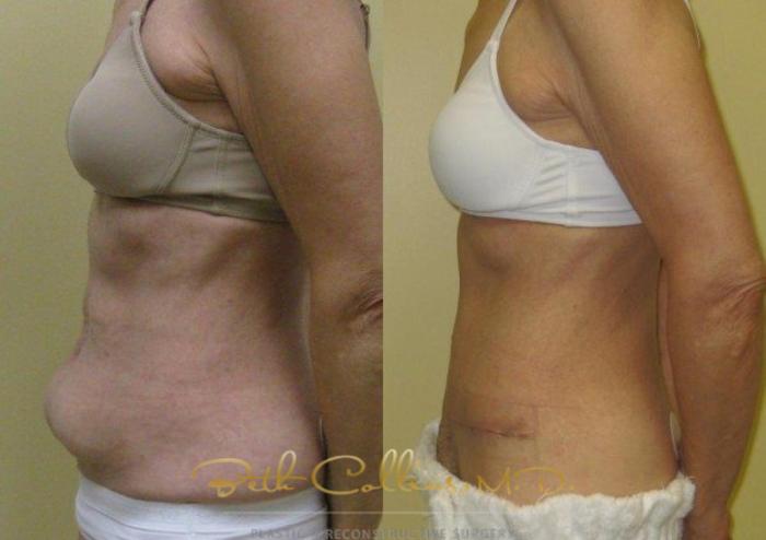 Before & After Tummy Tuck Case 6 View #6 View in Guilford, CT