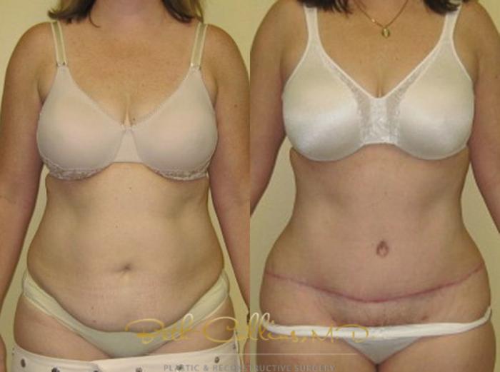 Before & After Tummy Tuck Case 7 View #1 View in Guilford, CT