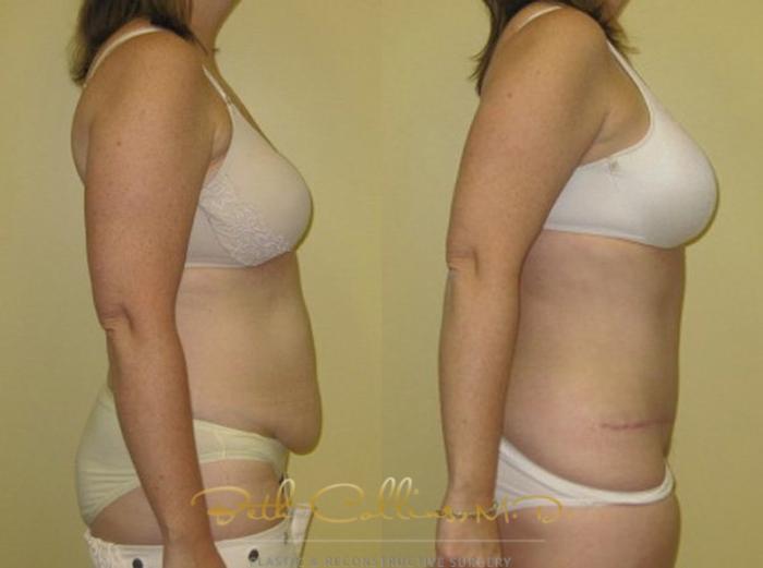 Before & After Tummy Tuck Case 7 View #2 View in Guilford, CT