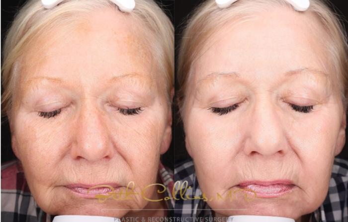 Before & After VISIA Skin Analysis Case 221 Front View in Guilford, CT